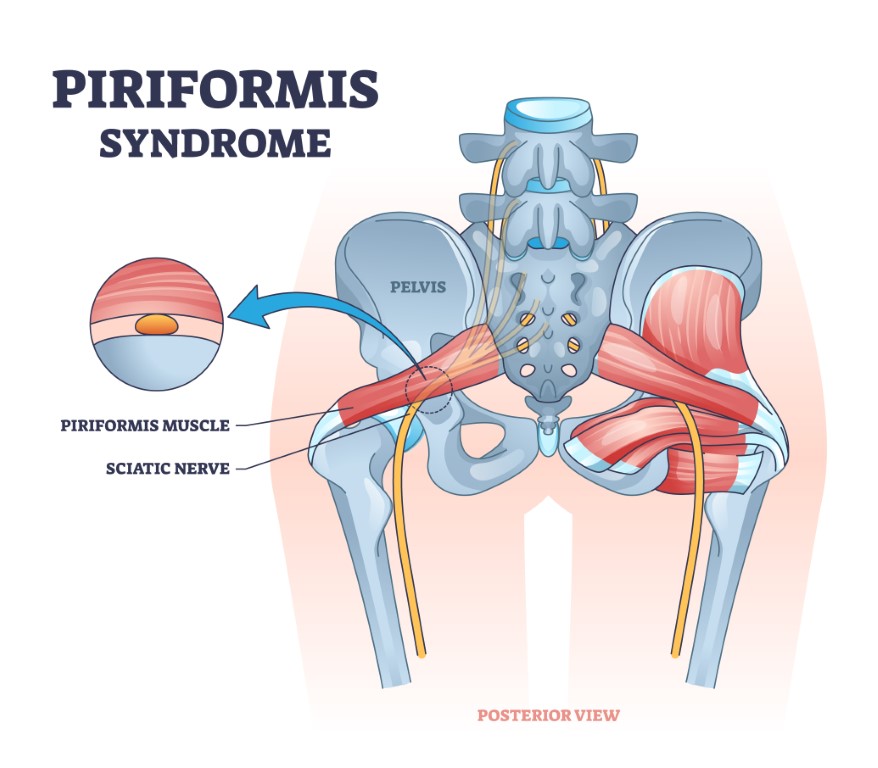 Illustration représentant le syndrome du piriforme