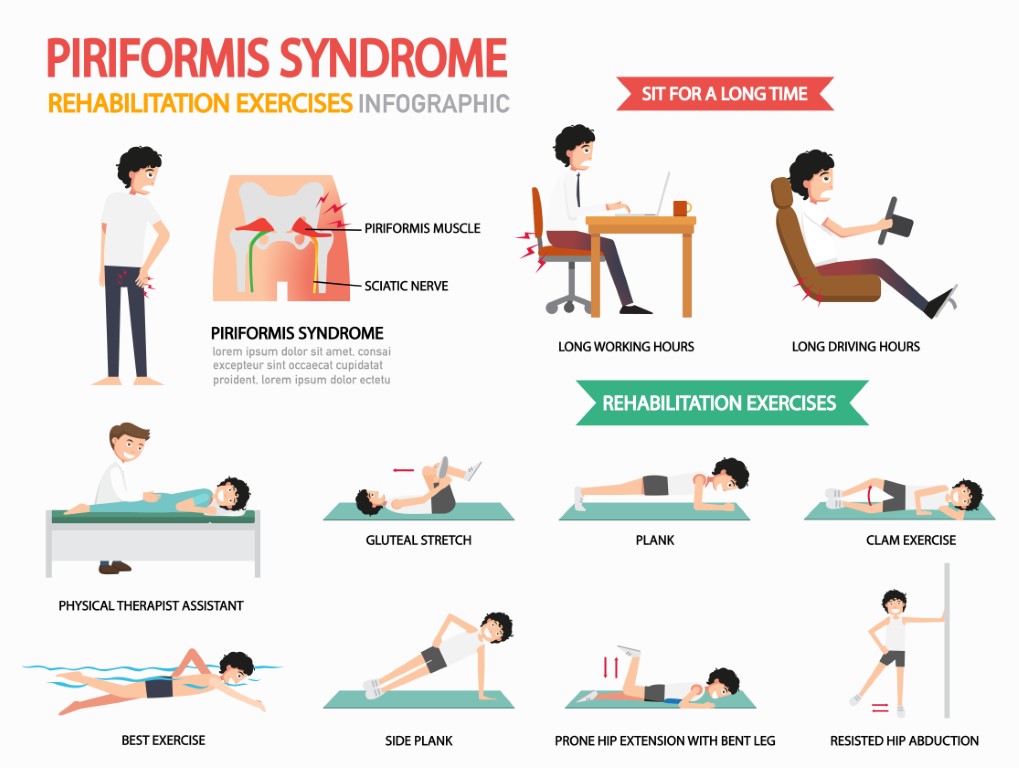 Les différents traitements et exercices possibles contre le syndrome du piriforme