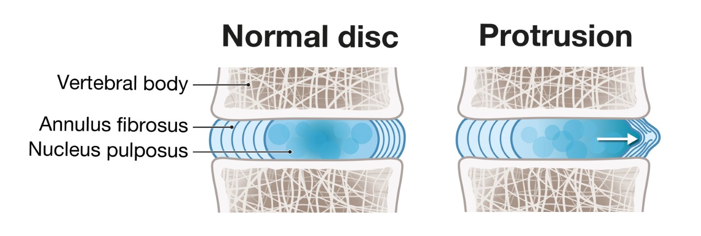 Différence entre vertèbre normale et protrusion discale