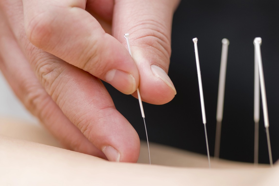 acupuncture en médecine douce